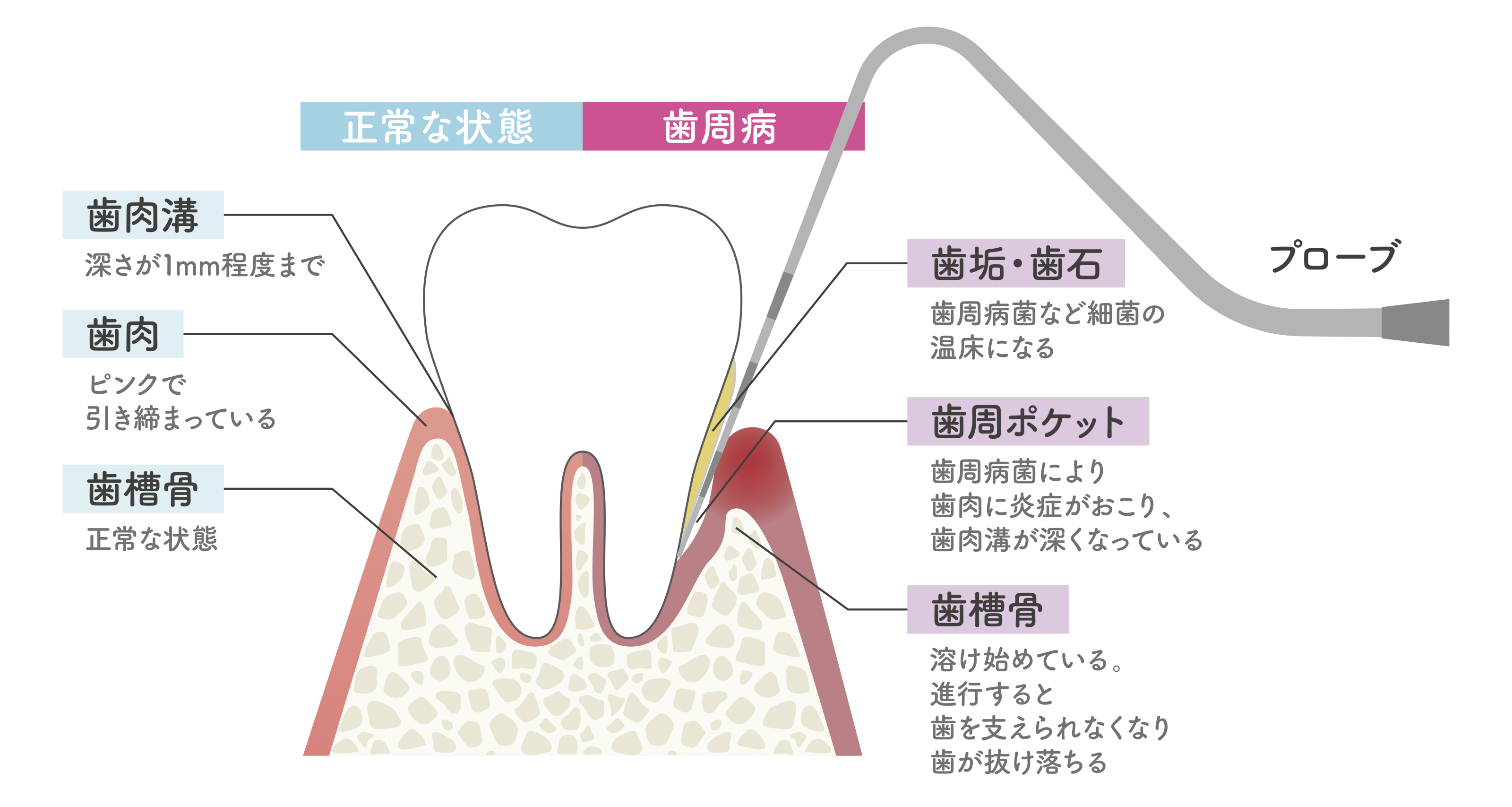 歯周病